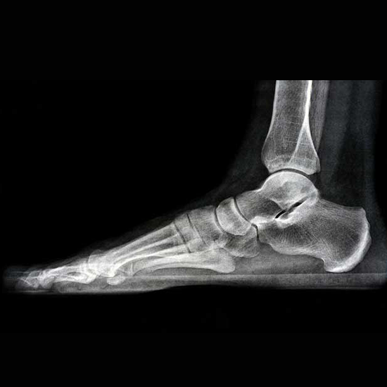 X-Ray Foot Lateral View (Right/Left) Procedure